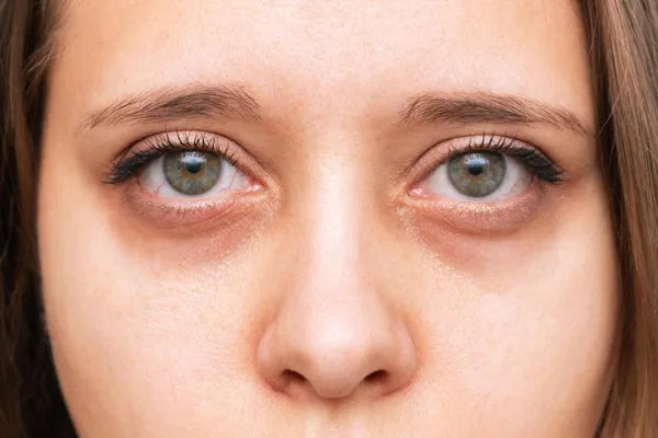 What Is The Difference Between Eye Bags, Puffy Eyes, and Dark Circles? - Healthy Skin Lab