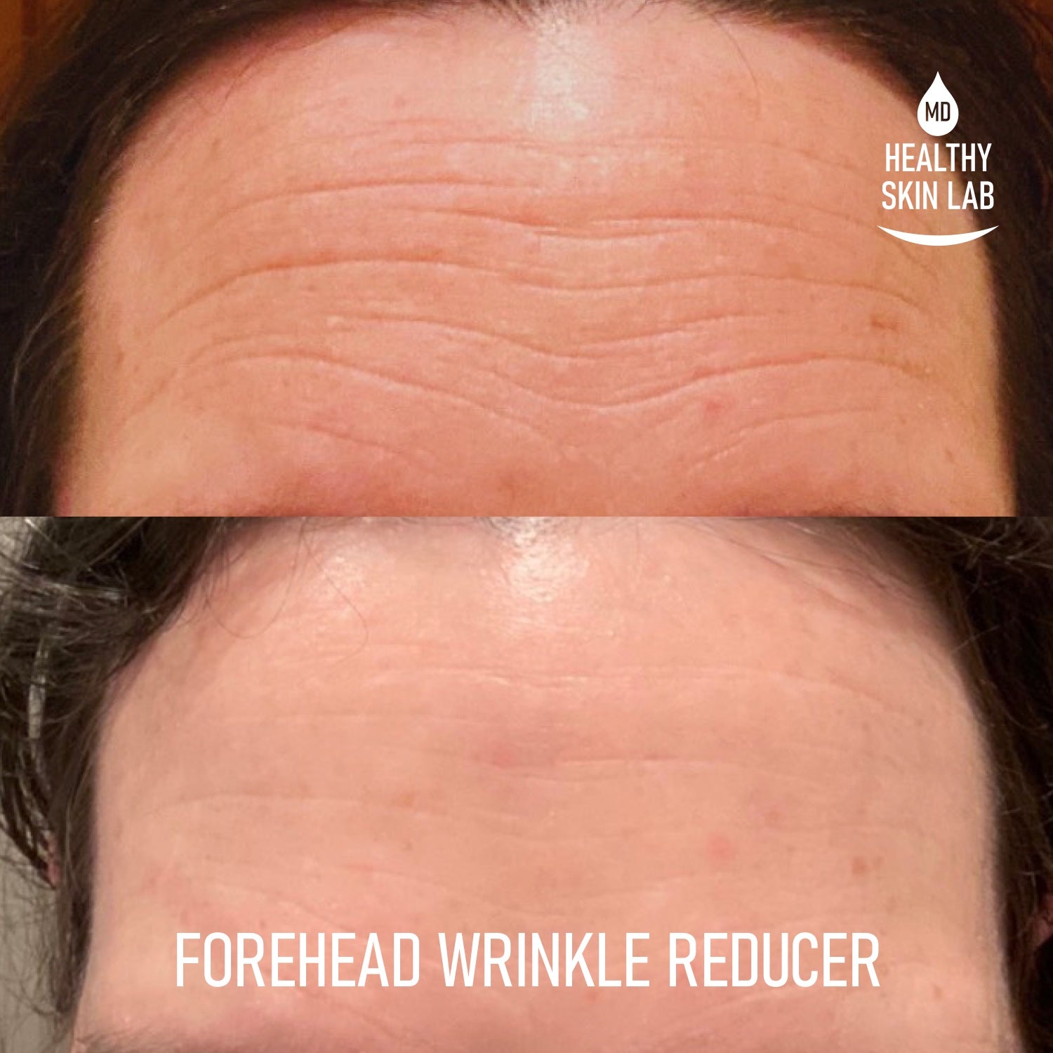 Reusable Silicone Forehead Patch